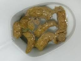 Image result for acholic stools human