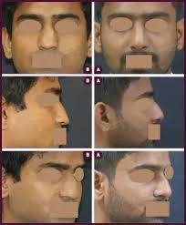 Price in us $ starts at. Affordable Nose Surgery Cost From Best Rhinoplasty Surgeon In Mumbai India