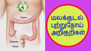 Stomach cancer in its early stages does not show any visible or specific symptoms and is therefore difficult to be diagnosed. à®®à®²à®• à®• à®Ÿà®² à®ª à®± à®± à®¨ à®¯ à®• à®°à®£à®® à®® à®…à®± à®• à®± à®¯ à®® Symptoms Colorectal Cancer In Tamil Youtube