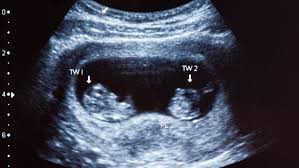 Twin Pregnancy 10 Weird Signs You Re Carrying Two Babies
