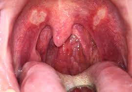 Üblicherweise treten aphten im mundraum auf, am zahnfleisch, den mandeln, der zunge oder der mundschleimhaut. Aphthe Wikipedia