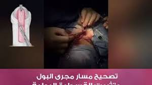 عملية الاحليل السفلى مع الاستاذ الدكتور وائل غانم وشرح مباشر بالفيديو لخطوات العملية