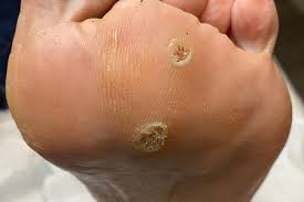 Image result for verrucae filiformes