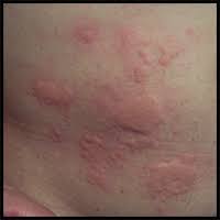 Behalve dikke, rode bulten, nooit iets aan de hand. Huiduitslag En Jeuk De Mogelijke Oorzaken