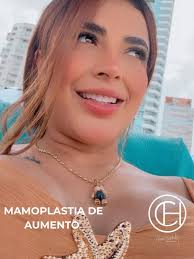Este es otro caso de éxito, paciente post quirúrgica de Mamoplastia de  aumento., Quieres agendar una cita 📲3187441811, #cirugiaplástica  #mamoplastiacali