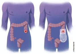 Cancers Du Colon La Chirurgie Cancer Du Colon