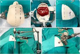Neuroendoscopic training in neurosurgery: a simple and feasible model for  neurosurgical education