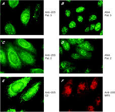 Image result for ANA Staining Pattern