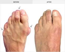 Silicone Hammer Toe Corrector Buy Lowest Prices Today Bizzoby Hammer Toe Hammer Toe Correction Toe Straightener