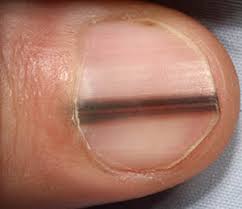 Image result for dark line beneath nails