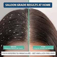 Image result for lice vs dandruff
