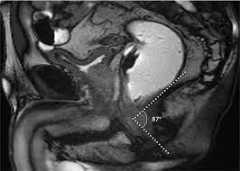 Not only mri pelvis muscle anatomy, you could also find another pics such as pelvic mri anatomy, female pelvic mri anatomy, female pelvis mri axial, pelvic muscles. Mri Of The Male Pelvic Floor Radiographics