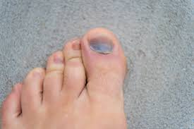 Check spelling or type a new query. An Overview Of Common Toenail Problems