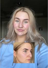 Solución para el acné con X Volcano Skin