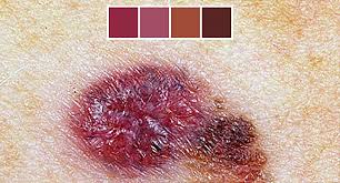 We asked dermatologists to weigh in on what different types of skin cancer look like, including squamous cell carcinoma, basel cell carcinoma, melanoma, and more. Skin Cancer Photos What Skin Cancer Precancerous Lesions Look Like