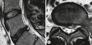 Why Do Annular Tears Hurt So Much Sohrab Gollogly Md
