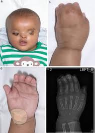 Image result for Syndactyly