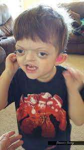 Mom Responds To Cruel Meme About Her Son With Craniofacial Disorder Huffpost Life