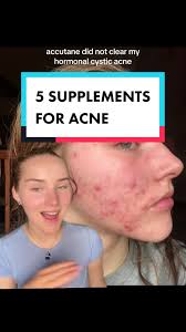 Top 5 Supplements for Acne