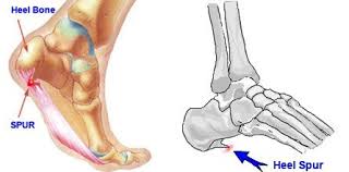 Heel Bone Spurs Bone Spurs Heal Spurs Heel Spurs