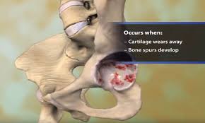 Osteoarthritis is a condition that causes joints to become painful and stiff. Osteoarthritis Orthoinfo Aaos