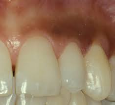 Why Are My Gums Black What Causes Changes In Gum Color Jefferson Dental Orthodontics