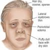 Find out what is myasthenia gravis (mg) and what causes it? 3