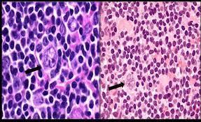Microscopic Picture Of Nodular Lymphocyte Predominant Hl Showing Download Scientific Diagram