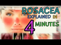 Rosacea tritt häufiger bei erwachsenen und wird nicht durch geschwollene mitesser oder pickel begleitet. Acne Rosacea Rosacea Explained In 4 Minutes Types Of Rosacea Causes Treatment Of Rosacea Youtube