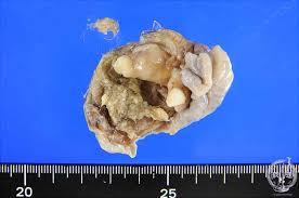 Cyst with hair and teeth on ovary. 15 Female Genital Organs 9 Mature Cystic Teratoma Of The Ovary Pathology Core Pictures