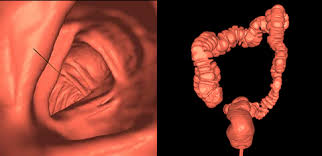 Image result for Virtual Endoscopy