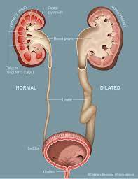 Urinary Tract Dilatation Midwest Fetal Care Center