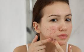Image result for acne face
