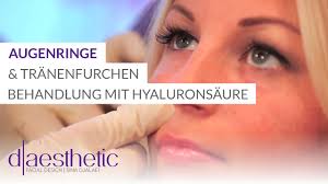 Erfahren sie hier, woher als augenringe bezeichnet man eine dunkle schattierung der haut rund um die augen, die meist. Augenringe Unterspritzen D Aesthetic Dr Sina Djalaei