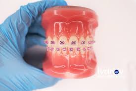 We even offer plans that cover braces and implants. Dental Insurance Plans For Braces Dental Insurance Orthodontist Near Me