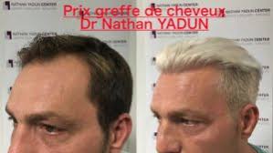 Comment soulager les symptômes de guérisons. Prix Greffe De Cheveux Tarif Implant Capillaire Rouen Proche Paris France