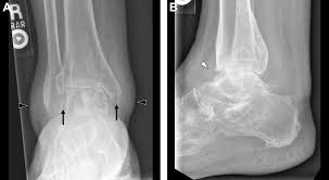 Image result for XRay Changes in Rheumatic Conditions
