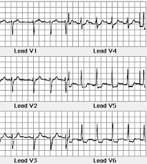 Hta, astm bronsic, rinichi unic chirurgical, bloc major de ramură dreaptă, cardiopatie ischemică. Http Fiziologie Umft Ro Ro Cv4 Ecgtrasee Pdf