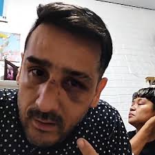 Wajah Lebam, Claudio Martines Buka Suara soal Pengeroyokan Pelayan Bar