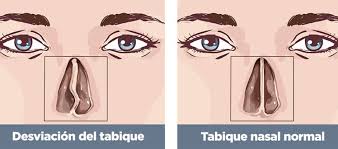 If your wall is way off, you have. What Can Be Done To Correct A Deviated Septum