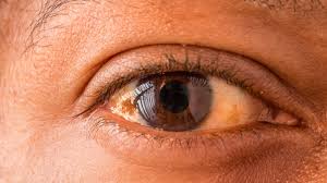 Image result for melanosis sclera