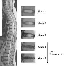 Prevalence And Distribution Of Intervertebral Disc Degeneration Over The Entire Spine In A Population Based Cohort The Wakayama Spine Study Osteoarthritis And Cartilage