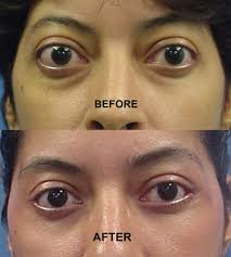 View actual before and after photos of patients treated with tepezza for thyroid eye disease, and other results from clinical studies. Thyroid Eye Disease Blepharoplasty Cosmetic Eyelid Surgery Graves Dallas Grant Gilliland
