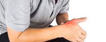 5 Signs Of A Thumb Sprain | The Hand Society