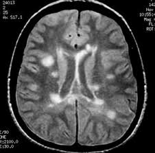 Multiple lesions in different regions of the brain) but also in time. Pin On Ms