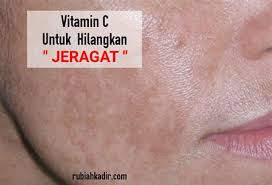 Maklumbalas yang sangat positif daripada pengguna dan sangat disyorkan bagi anda yang mengalami masalah jeragat! Krim Jeragat Di Farmasi Ubat Jeragat Paling Berkesan Di Farmasi Residence E Cream Wajah Racikan Dokter Cream Wajah Yang Bagus Krim Jerawat Krim Jerawat Ampuh Krim Jerawat Di Farmasi Hachid Hend