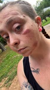 meaning of post concussion sydrom