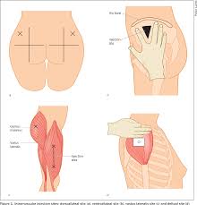 The deltoid muscle is one of the im injection sites you can use to administer. Figure 1 From Intramuscular Injection Climat Pathway A Clinical Practice Guideline Semantic Scholar