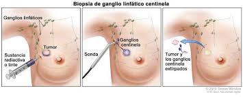 Pin En Cancer De Mama