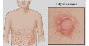 Called a herald patch, this spot can be up to 4 inches (10 centimeters) across. Pityriasis Rosea Www Medicoapps Org